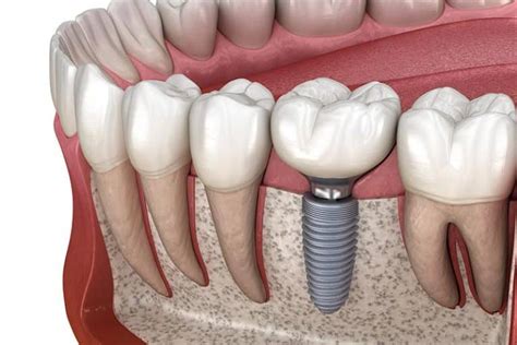 dental implants ashford